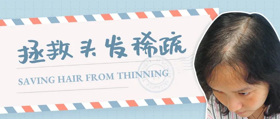 头顶越来越薄？拯救头发稀疏，你试过里面哪些方法？