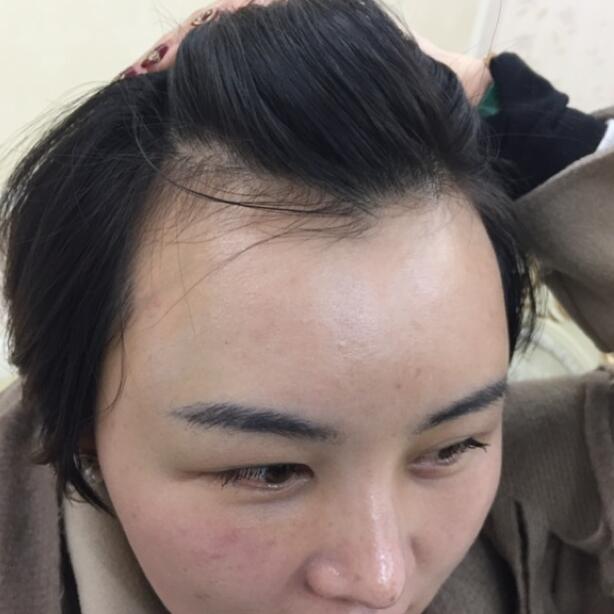 过年了发际线也要变美，我的发际线种植术后效果分享