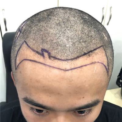 贵阳丽都治疗脱发效果好不好 术后真人案例分享