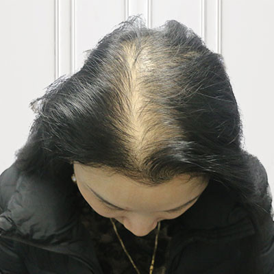 头顶加密种植，给了我外貌上的第二春