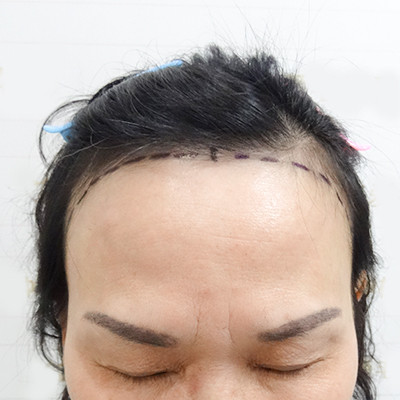 年龄不是问题，想做发际线就做