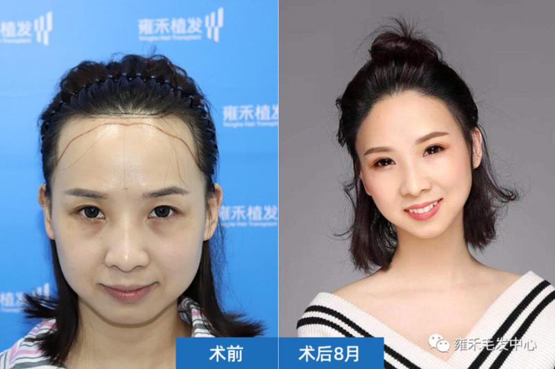 青岛雍禾的植发医生就说了只是打麻药的时候疼点