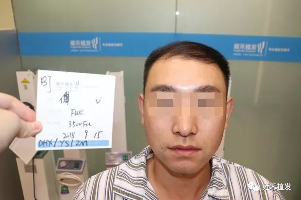 没钱植发贷款植发没戏，开滴滴攒钱植发形象逆转