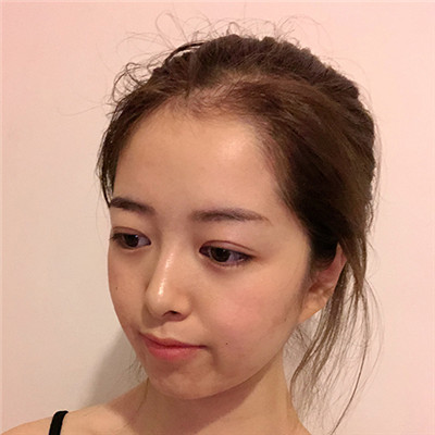 深圳鹏程做发际线加密治疗效果分享