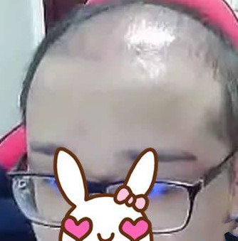 秃顶植发，术后效果真实案例分享