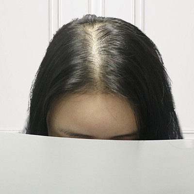 三四十岁的女性怎么能被脱发打败，做个头顶加密让我更加美丽