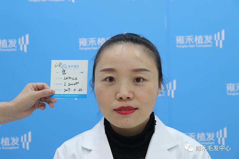 张医生植发做各种准备设计的是韩式发际线