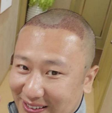 发际线后退？不怕，有发际线种植手术，效果真心不错