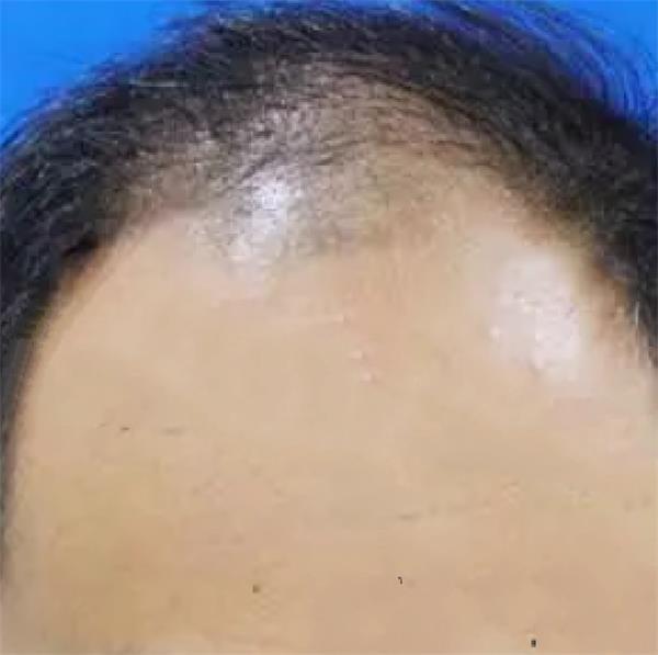 M型脱发治疗，植发手术真实案例分享