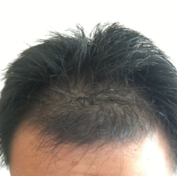 我在西安碑林科大做的发际线种植手术案例分享