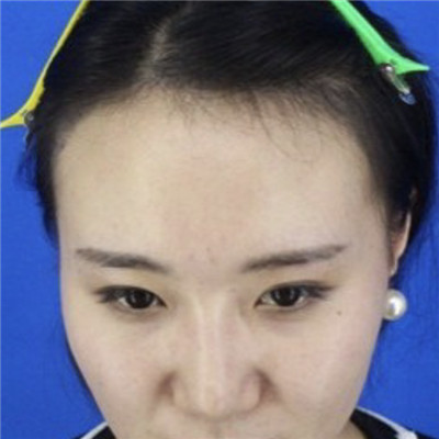 光鲜亮丽的人也可能发际线后退，植发帮我重回美丽