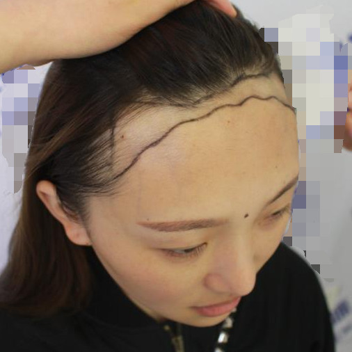 想扎丸子头但是发际线太高？那就做个发际线实现梦想吧，术后效果分享