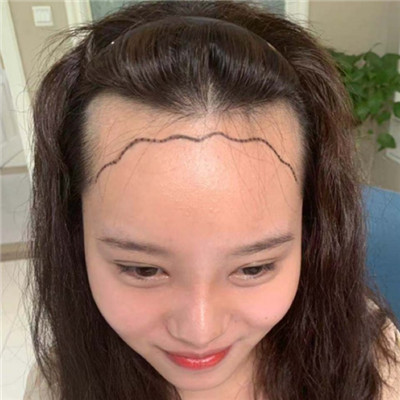 大额头灵气？不，我要做发际线变得更美，术后案例对比图