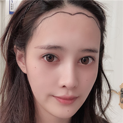五官不错但发际线太高，那就植个发际线平衡美丽，术后对比图