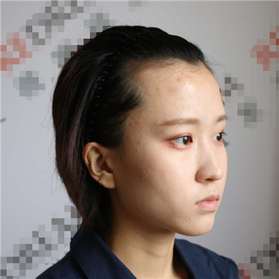 天生发际线高还脱发，赶紧做个植发际线拯救自己，术后效果对比图