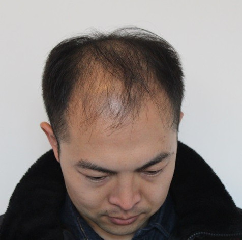 大面积植发4000毛囊单位手术经历记录，术后效果对比图