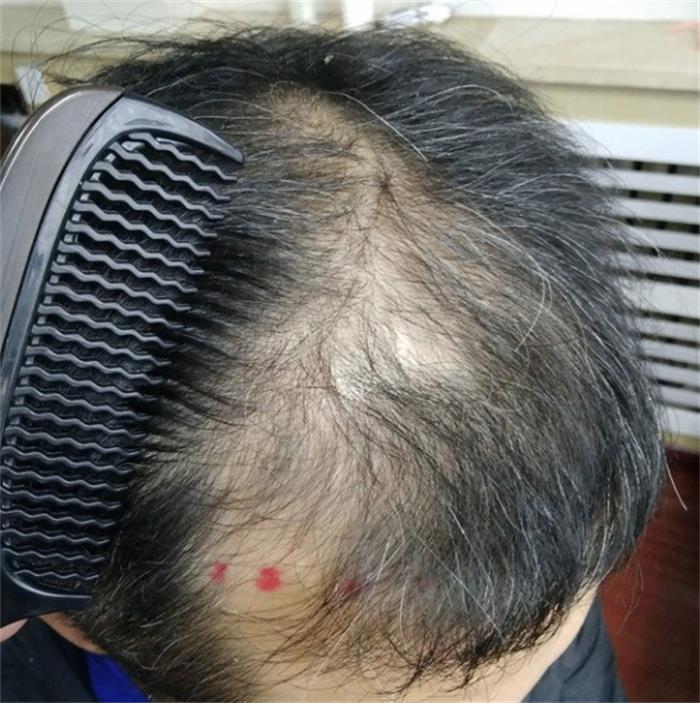 在重庆西南医院做发际线调整真实记录
