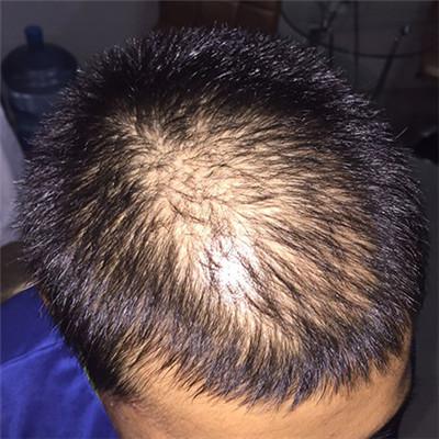 在青岛海伦做头顶加密种植真实恢复记录