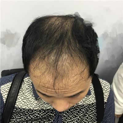 成都丝缘治疗我的秃顶，术后案例效果