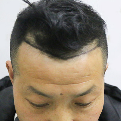 额角后退害怕秃顶，做个植发就好，术后案例对比图