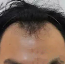拯救脱发之旅，看看我的植发效果如何