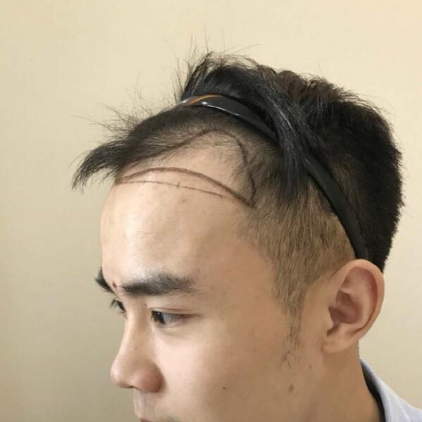 突然脱发怎么办？做个植发再也不会脱了