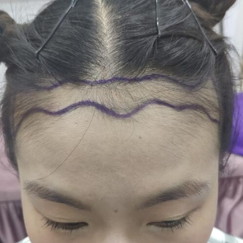 拔掉的头发一直没长回来？做个植发就让它回来