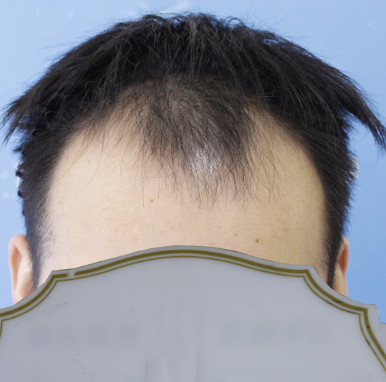 植发真的改变了我，让我重新找回了自信，我的术后对比图