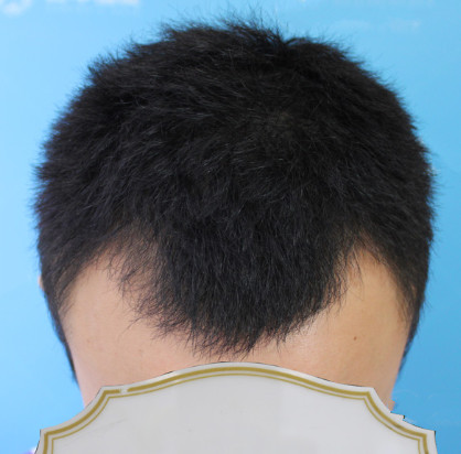 终于去做了发际线种植手术，感觉自己好像又变年轻了，术后案例对比图