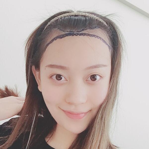 遗传老爸的高发际线？做个植发让你悄悄变美