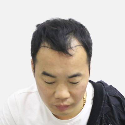 发际线也是决定颜值的一环，该植就要植