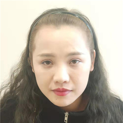 天生发际线高怎么办？做2500个植发单位就好，案例对比图