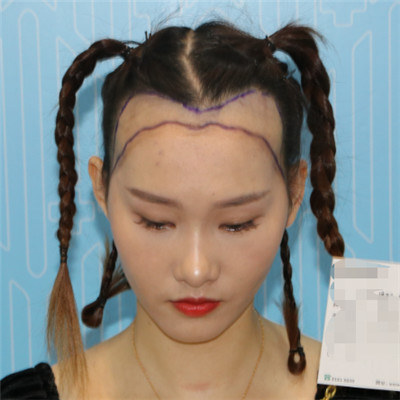 想让自己变得更完美，做个发际线就实现，我的术后案例