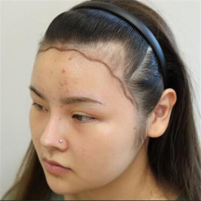 发际线太高脸又圆又大？植个发际线就好，我的术后效果对比图