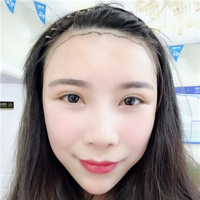 学习学到秃，植发际线拯救自己，术后效果对比图