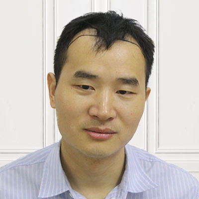 老腊肉也要注意发际线健康，做个发际线年轻十岁，术后效果对比图