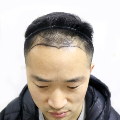 发际线疯狂后退，做植发际线就有效，术后案例分享