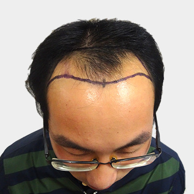 男人也要良好的个人形象，做个植发就能解决