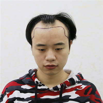 熬夜脱发怎么办？做个植发就恢复