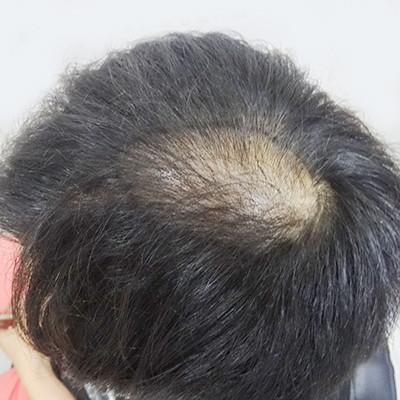 脱发让人看起来像五十多岁，做个加密让你重回年轻，术后效果案例分享