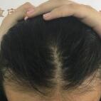 发际线种植手术，完美的解决发际线缺陷问题