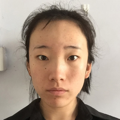 发际线高大脸超长，植发际线拯救我，术后对比图片