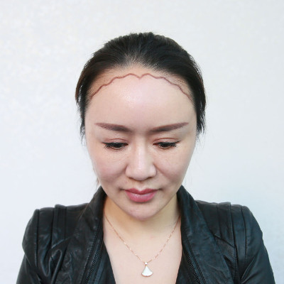 发际线太高脸部不和谐，做个发际线让你重回十八岁
