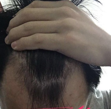 2000个单位种植，植发术后效果分享对比图片
