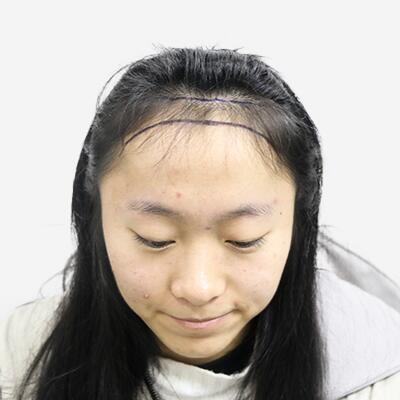 刘海不协调，植发让你自信露出额头改善面部协调