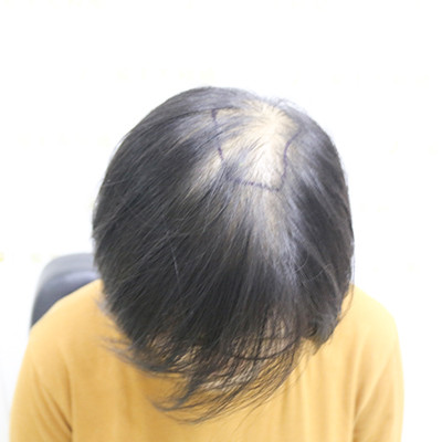 头顶严重稀疏显老？头顶加密种植术后效果前后对比图