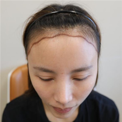 对自己颜值有严格要求就做个发际线吧，我的术后效果对比图