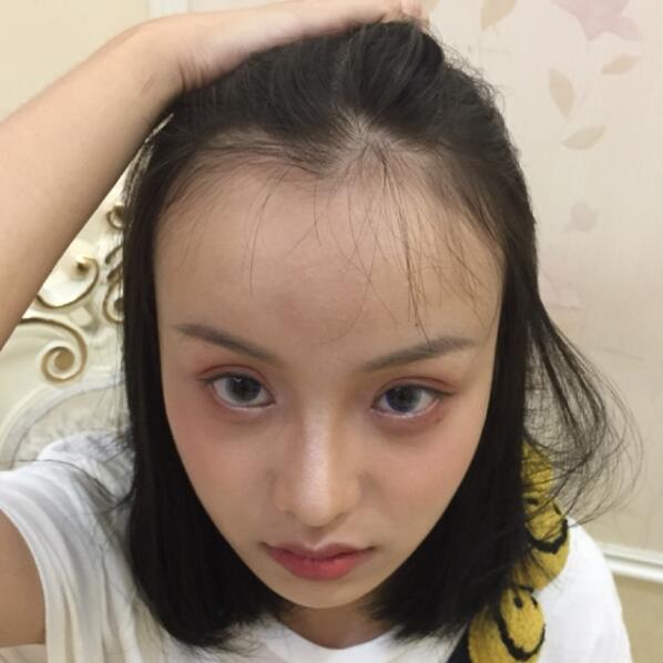 不想等头发全没了，做个植发让你停留在二十岁