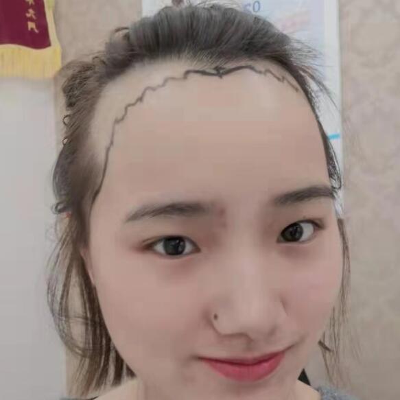 圆脸女孩发际线不完美？做个植发让自己不再脱发