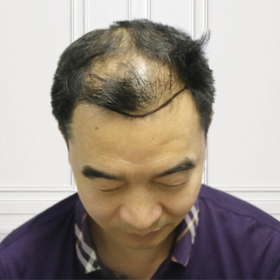 中年脱发身不由己？做个植发就改变